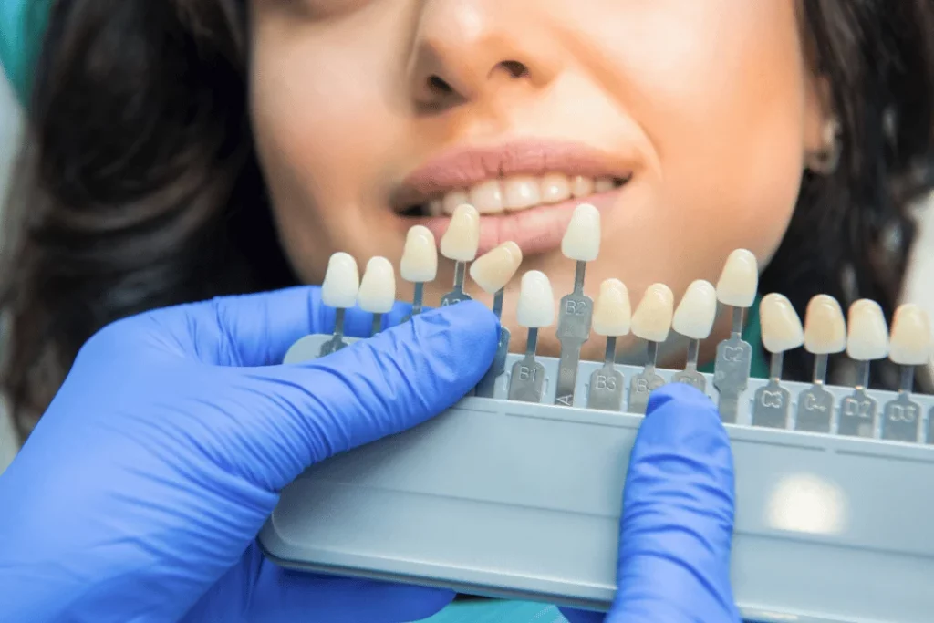 Porcelain Crowns for Cosmetic Restoration ventura