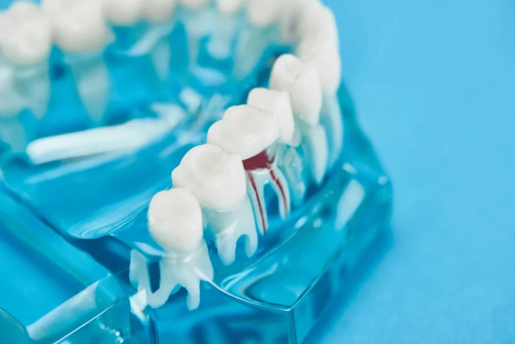 root canal ventura ca