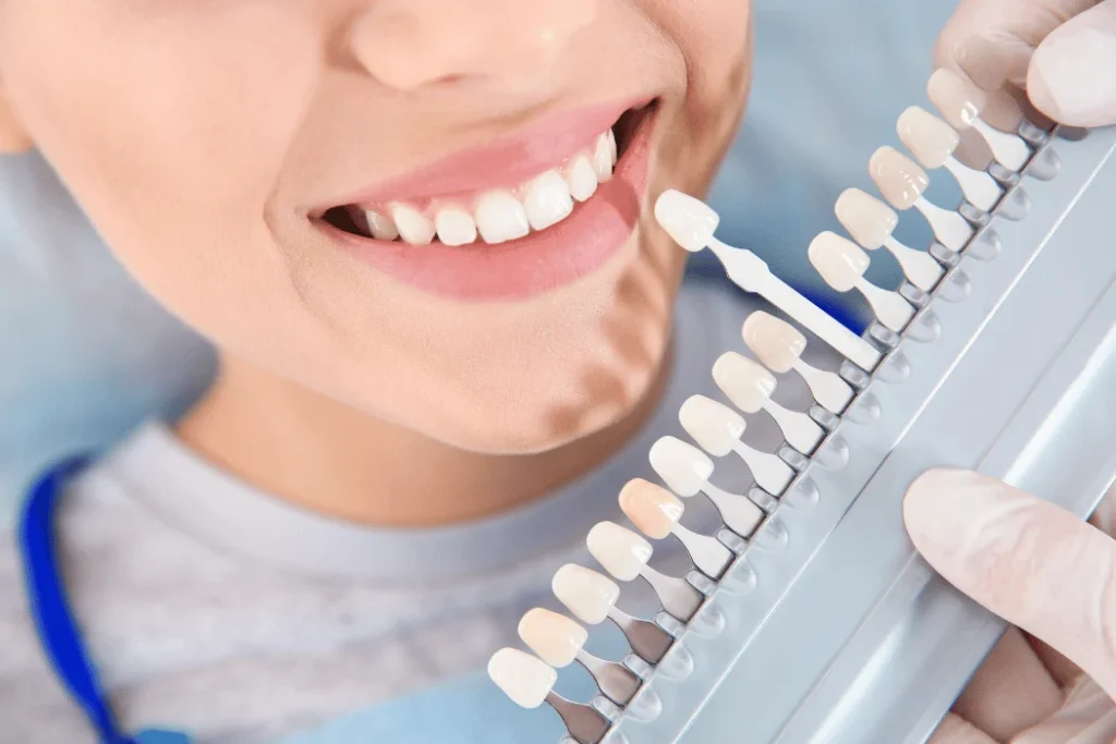 Professional Take-Home Teeth Whitening
