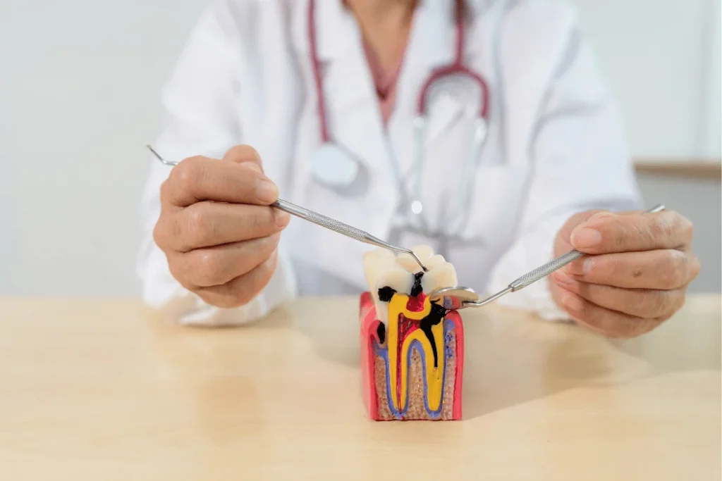 Trusted Root Canal Therapy